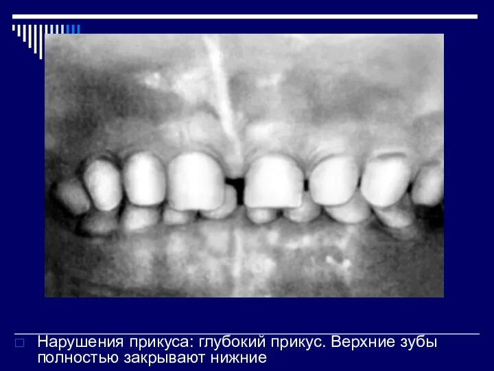 Нарушения прикуса: глубокий прикус. Верхние зубы полностью закрывают нижние