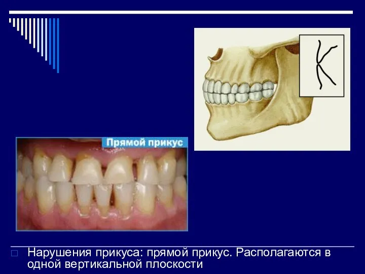 Нарушения прикуса: прямой прикус. Располагаются в одной вертикальной плоскости