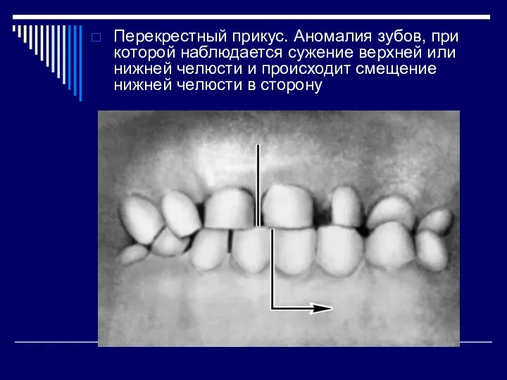 Перекрестный прикус. Аномалия зубов, при которой наблюдается сужение верхней или нижней челюсти