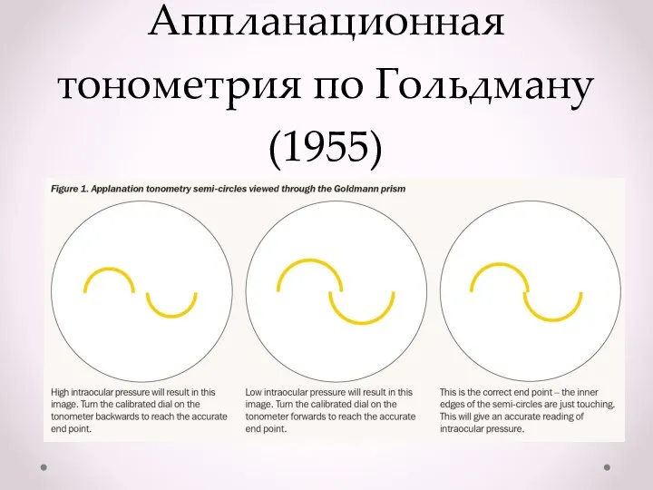 Аппланационная тонометрия по Гольдману (1955)