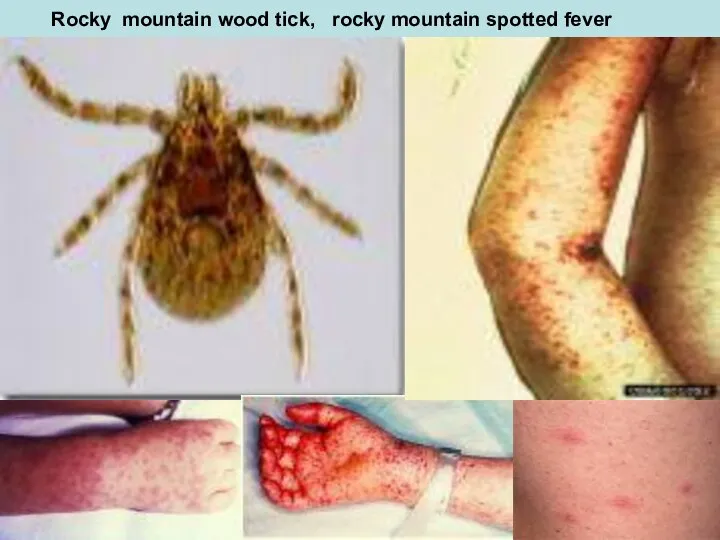 Rocky mountain wood tick, rocky mountain spotted fever