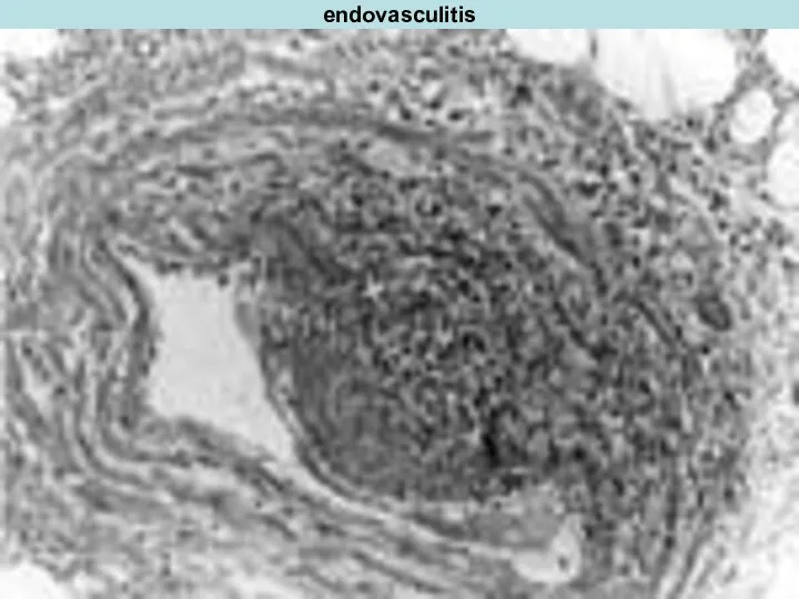 endovasculitis