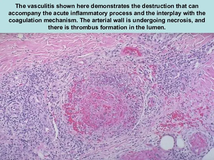 The vasculitis shown here demonstrates the destruction that can accompany the acute