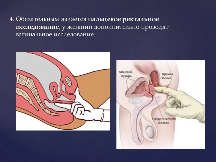 4. Обязательным является пальцевое ректальное исследование, у женщин дополнительно проводят вагинальное исследование.