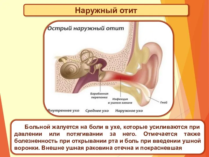 Наружный отит Больной жалуется на боли в ухе, которые усиливаются при давлении