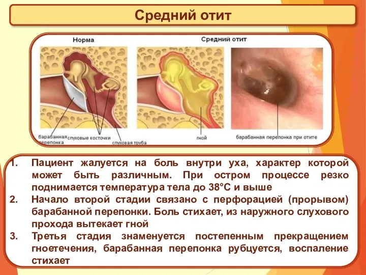 Средний отит Пациент жалуется на боль внутри уха, характер которой может быть