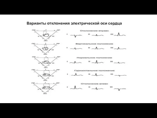 Варианты отклонения электрической оси сердца