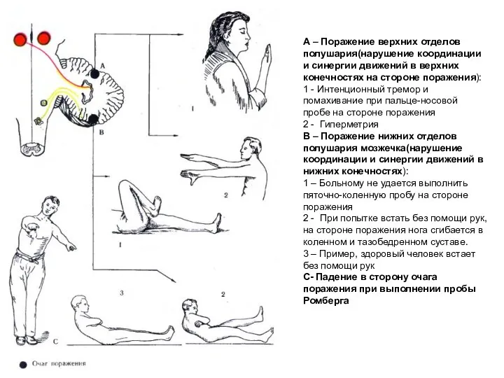 А – Поражение верхних отделов полушария(нарушение координации и синергии движений в верхних