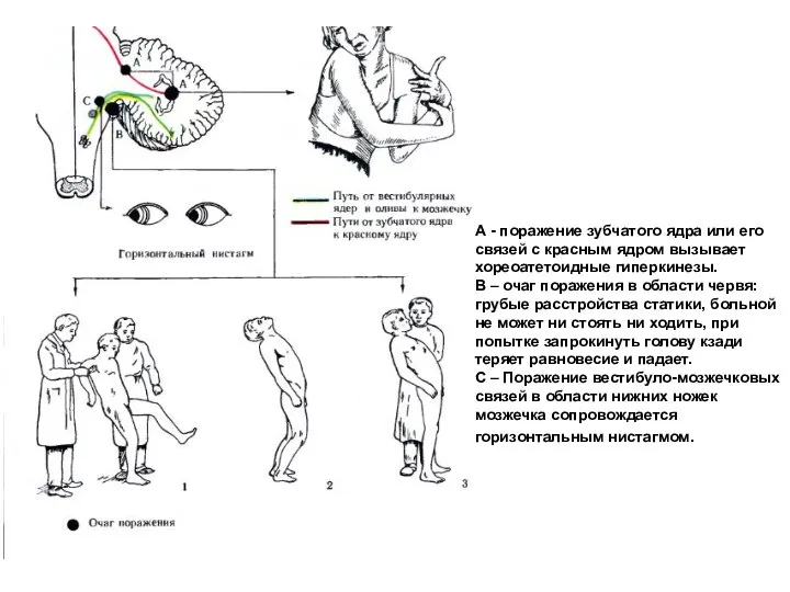 А - поражение зубчатого ядра или его связей с красным ядром вызывает