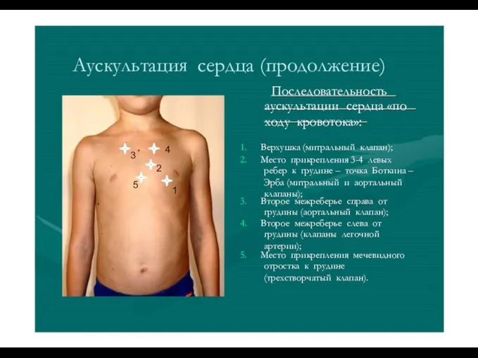 Аускультация сердца (продолжение) Последовательность аускультации сердца «по ходу кровотока»: 3 2 5