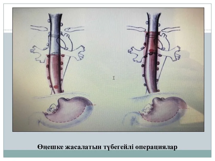 Өңешке жасалатын түбегейлі операциялар