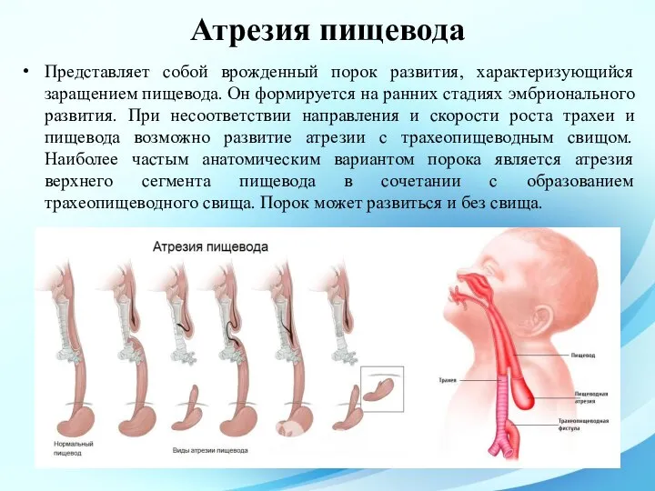 Представляет собой врожденный порок развития, характеризующийся заращением пищевода. Он формируется на ранних