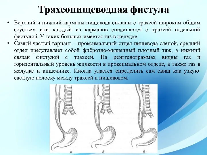 Верхний и нижний карманы пищевода связаны с трахеей широким общим соустьем или