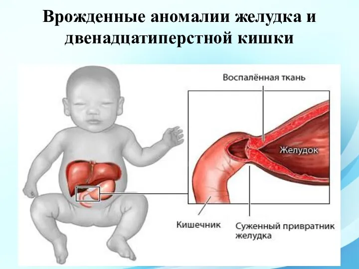 Врожденные аномалии желудка и двенадцатиперстной кишки