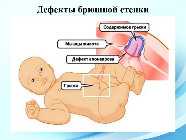 Дефекты брюшной стенки