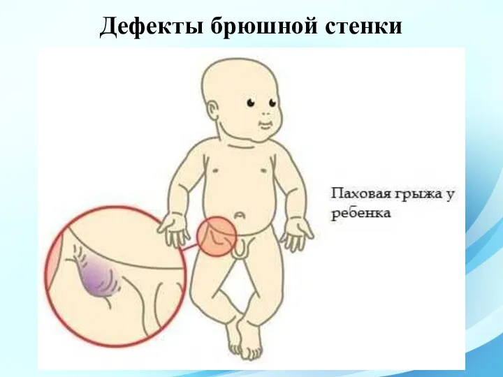 Дефекты брюшной стенки