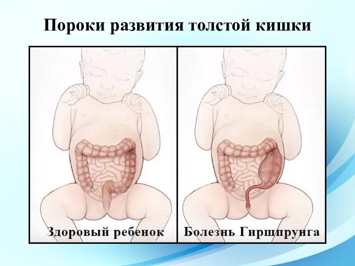 Пороки развития толстой кишки