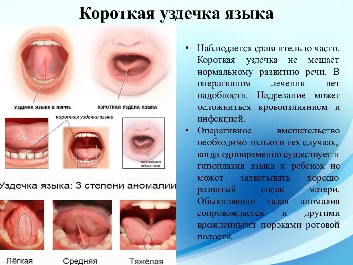 Наблюдается сравнительно часто. Короткая уздечка не мешает нормальному развитию речи. В оперативном