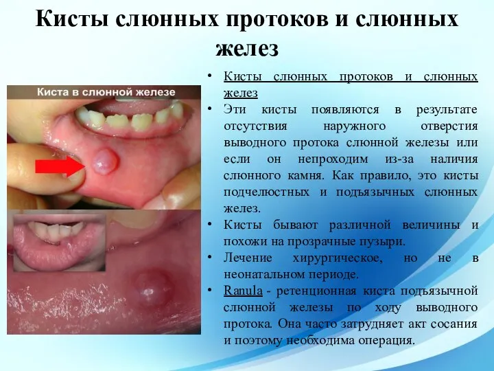 Кисты слюнных протоков и слюнных желез Эти кисты появляются в результате отсутствия