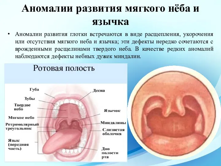 Аномалии развития глотки встречаются в виде расщепления, укорочения или отсутствия мягкого неба