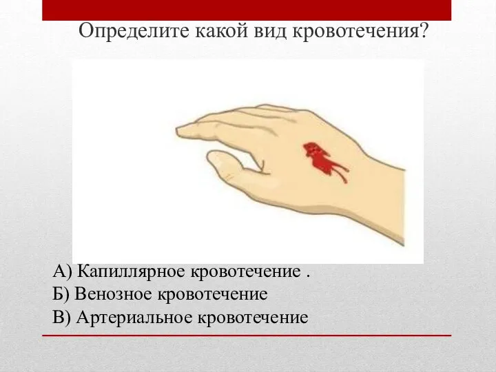 Определите какой вид кровотечения? А) Капиллярное кровотечение . Б) Венозное кровотечение В) Артериальное кровотечение