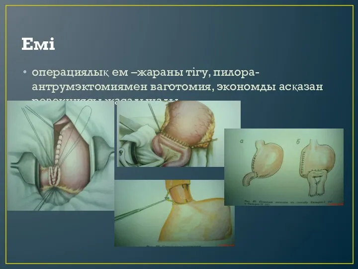 Емі операциялық ем –жараны тігу, пилора- антрумэктомиямен ваготомия, экономды асқазан резекциясы жасалынады.