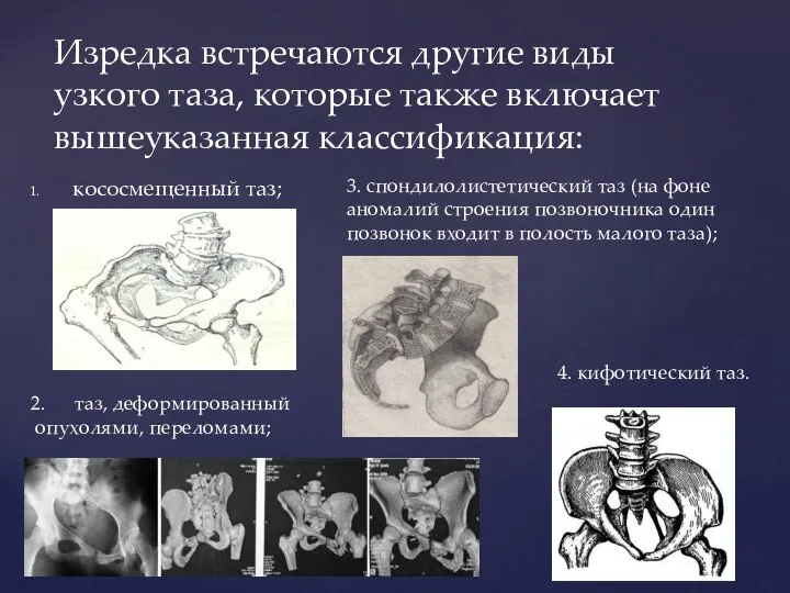 кососмещенный таз; Изредка встречаются другие виды узкого таза, которые также включает вышеуказанная