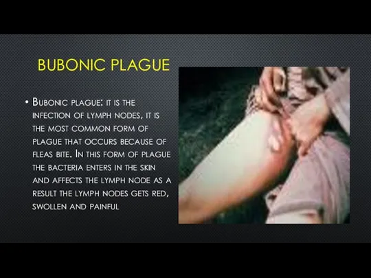 BUBONIC PLAGUE Bubonic plague: it is the infection of lymph nodes, it