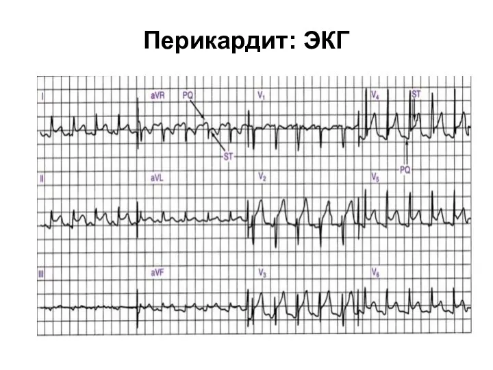 Перикардит: ЭКГ