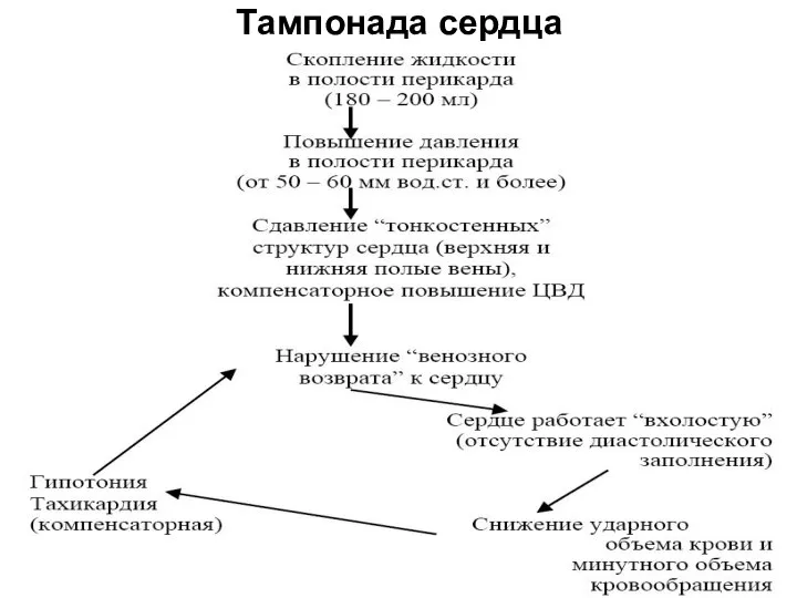 Тампонада сердца