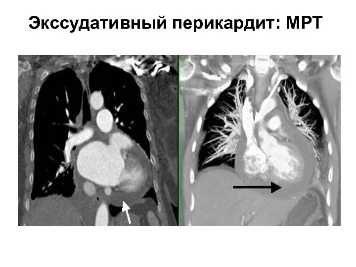 Экссудативный перикардит: МРТ