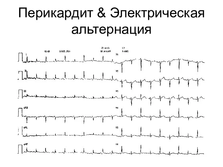 Перикардит & Электрическая альтернация