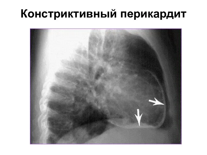 Констриктивный перикардит