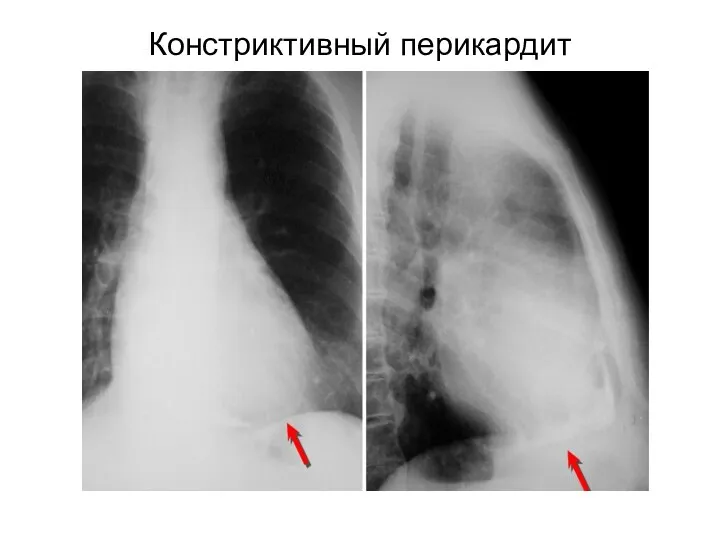 Констриктивный перикардит