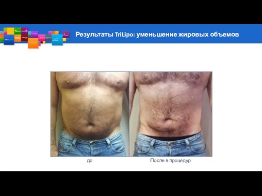 Результаты TriLipo: уменьшение жировых объемов до После 6 процедур