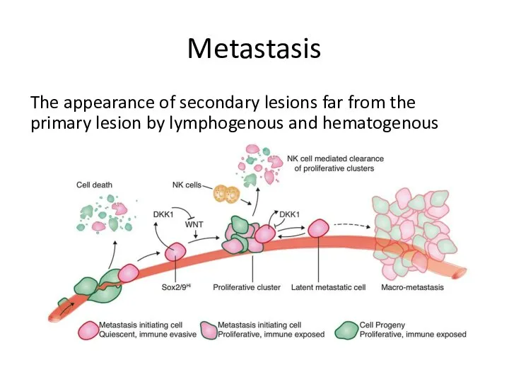 Metastasis The appearance of secondary lesions far from the primary lesion by lymphogenous and hematogenous