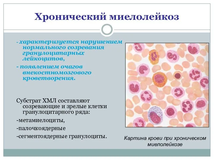 Хронический миелолейкоз - характеризуется нарушением нормального созревания гранулоцитарных лейкоцитов, - появлением очагов