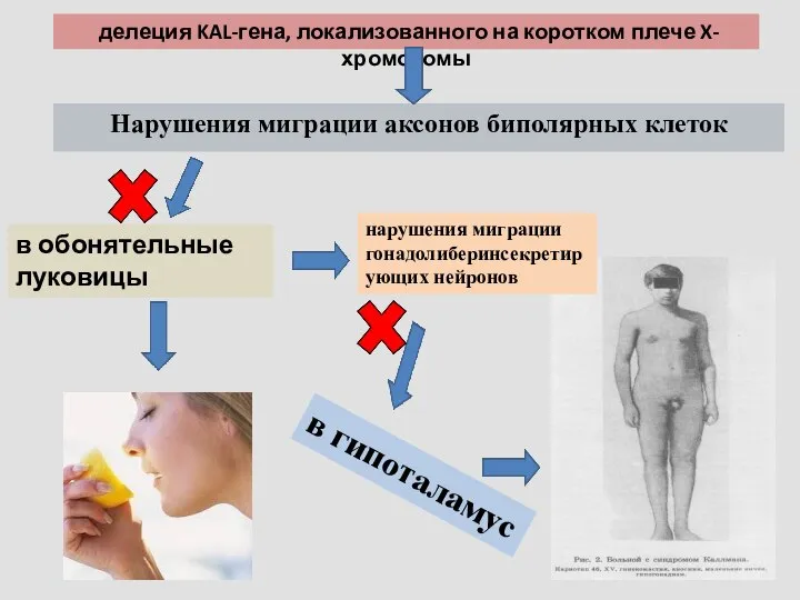 Нарушения миграции аксонов биполярных клеток в обонятельные луковицы нарушения миграции гонадолиберинсекретирующих нейронов