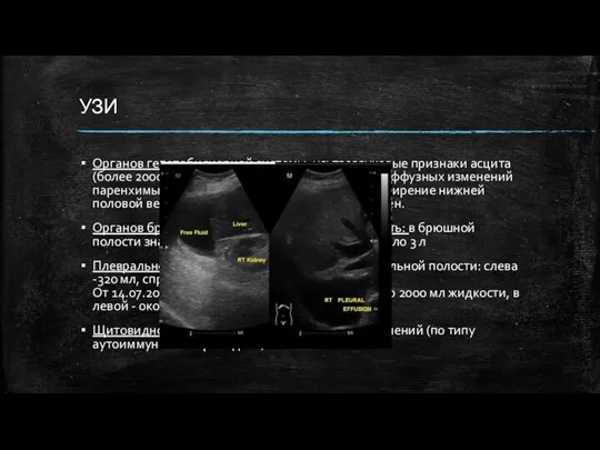 УЗИ Органов гепатобилиарной системы: ультразвуковые признаки асцита (более 2000 мл), увеличения размеров