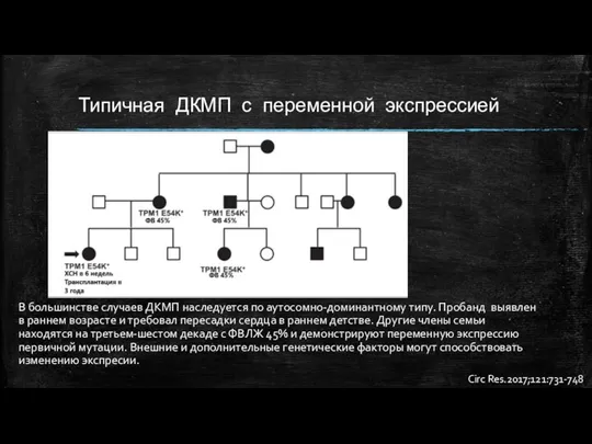 Типичная ДКМП с переменной экспрессией В большинстве случаев ДКМП наследуется по аутосомно-доминантному