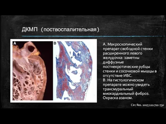 ДКМП (поствоспалительная) А. Макроскопический препарат свободной стенки расширенного левого желудочка: заметны диффузные