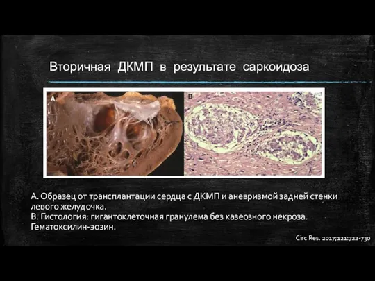 Вторичная ДКМП в результате саркоидоза А. Образец от трансплантации сердца с ДКМП