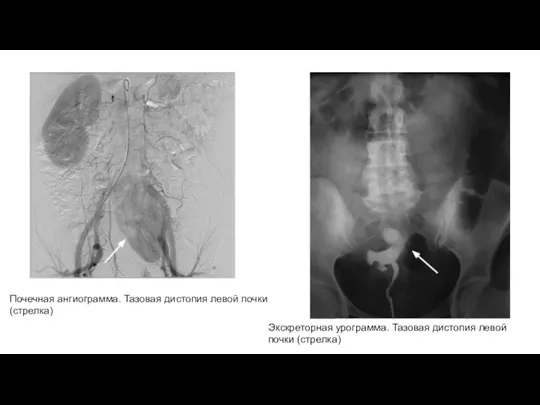 Почечная ангиограмма. Тазовая дистопия левой почки (стрелка) Экскреторная урограмма. Тазовая дистопия левой почки (стрелка)