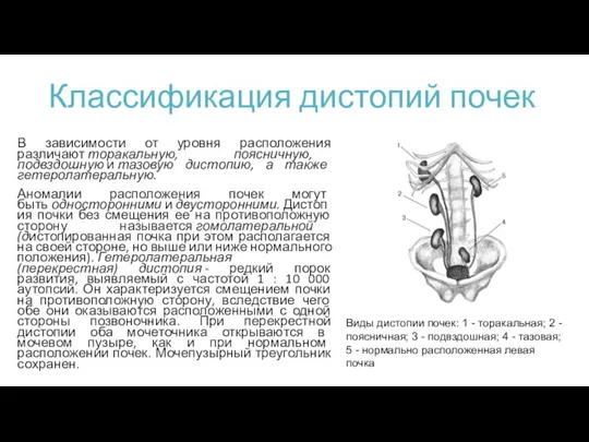 Классификация дистопий почек В зависимости от уровня расположения различают торакальную, поясничную, подвздошную