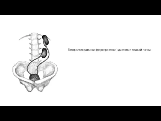 Гетеролатеральная (перекрестная) дистопия правой почки