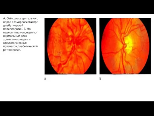 А. Отёк диска зрительного нерва с геморрагиями при диабетической папиллопатии. Б. На