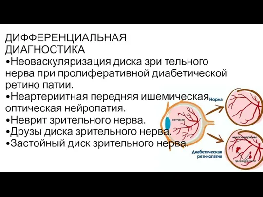 ДИФФЕРЕНЦИАЛЬНАЯ ДИАГНОСТИКА •Неоваскуляризация диска зри­ тельного нерва при пролифера­тивной диабетической ретино­ патии.