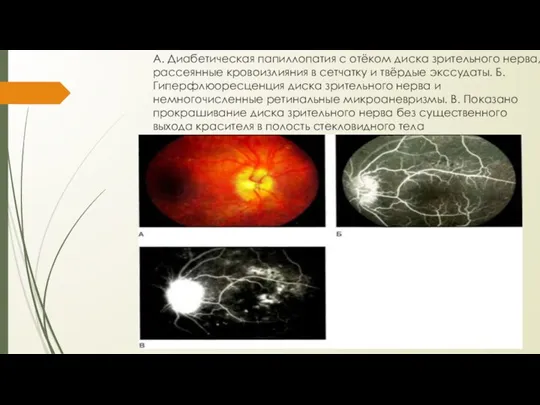 А. Диабетическая папиллопатия с отёком диска зрительного нерва, рассеянные кровоизлияния в сетчатку