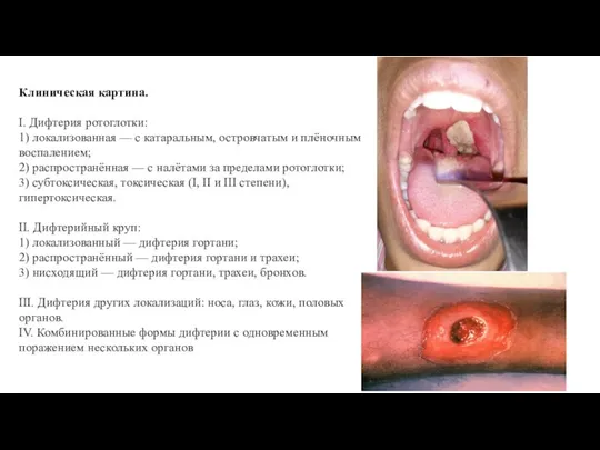 Клиническая картина. I. Дифтерия ротоглотки: 1) локализованная — с катаральным, островчатым и