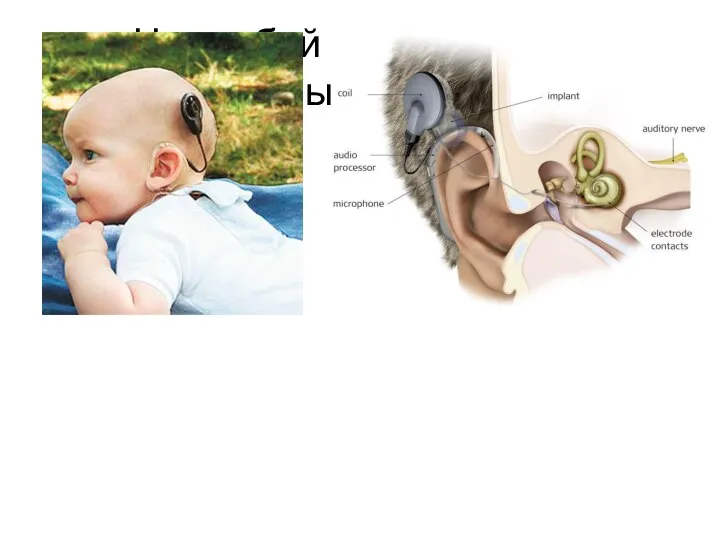 Что собой представляет кохлеарный имплантат?